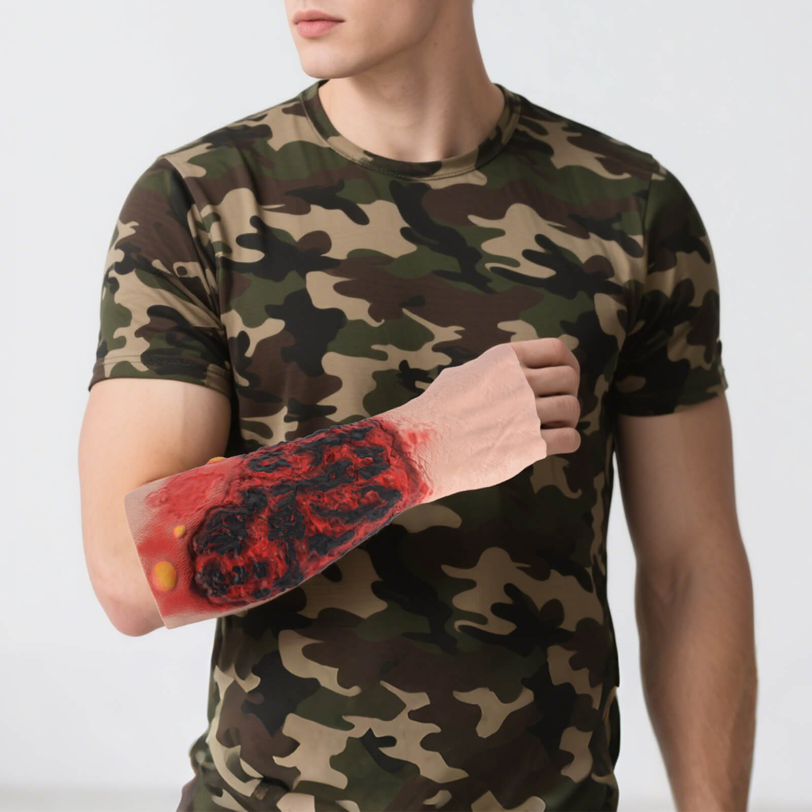 Wearable Forearm Burn Moulage