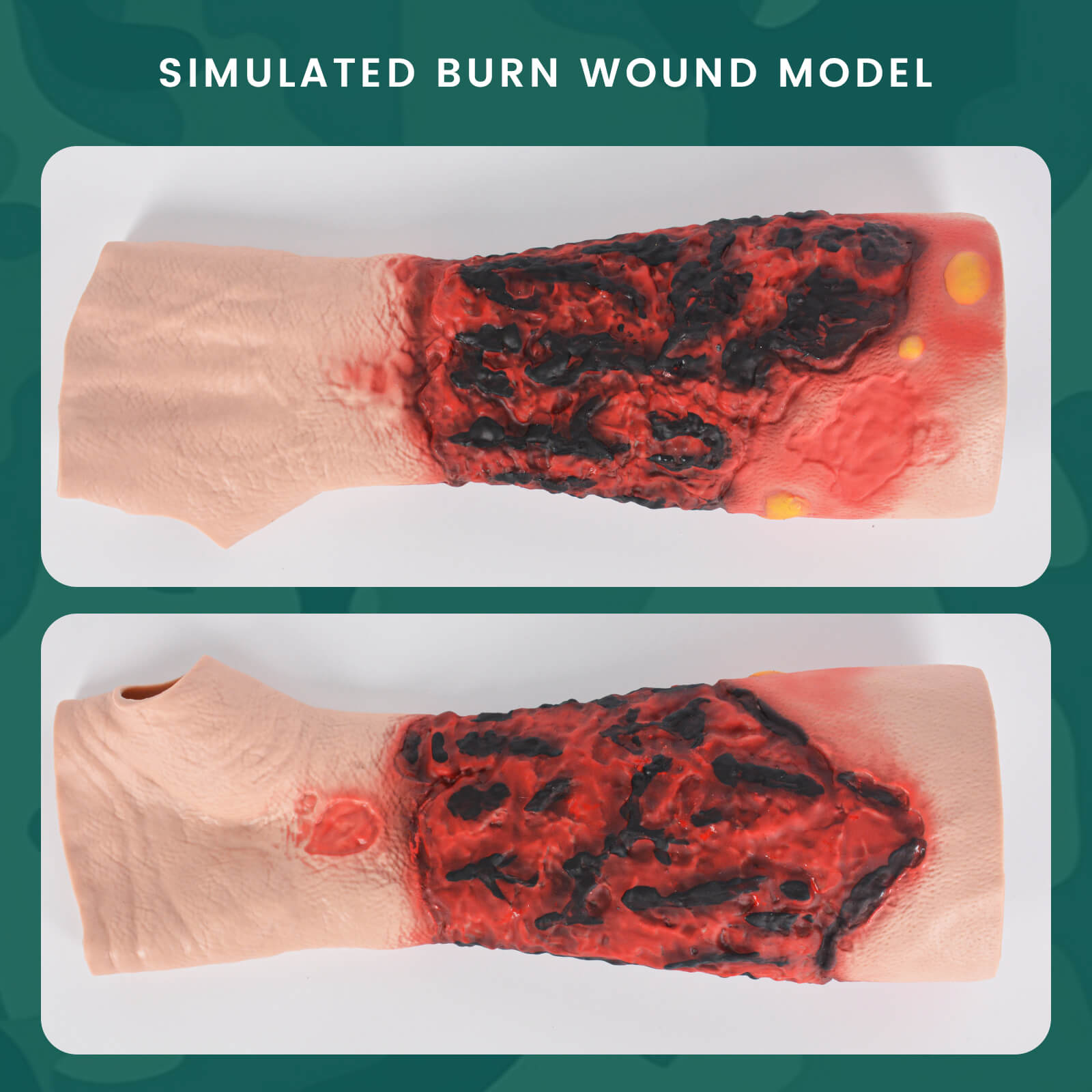 Wearable Forearm Burn Moulage