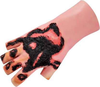 Wearable Hand Burn Moulage
