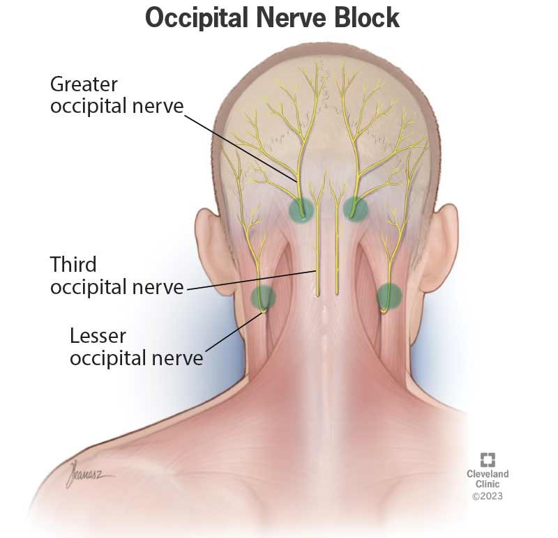 occipital nerve