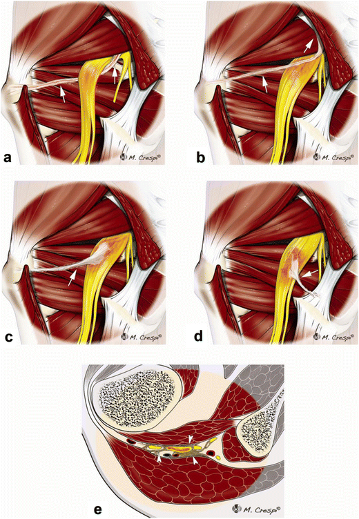 Deep Gluteal Syndrome