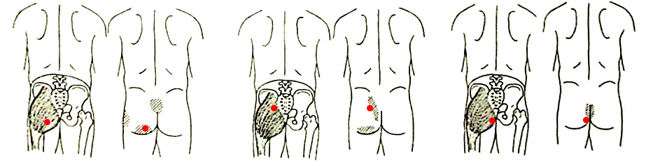 Gluteus Maximus trigger points