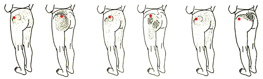 Gluteus Medius trigger points