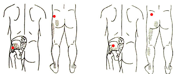 Gluteus Minimus trigger points