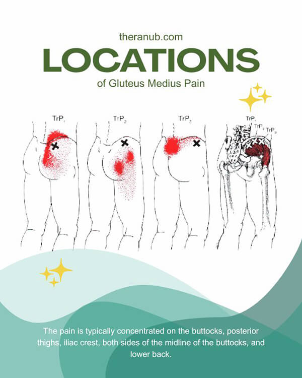 ​​Locations of Gluteus Medius Pain​
