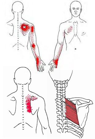 Rhomboid Trigger Points