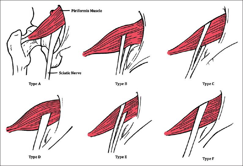 Secondary Piriformis Syndrome