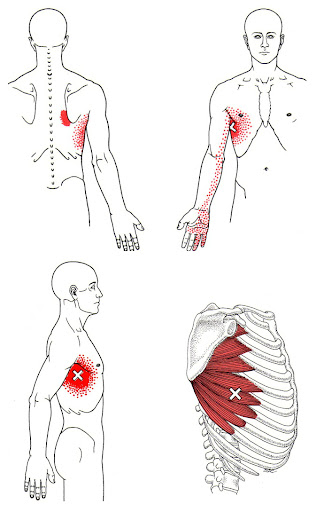 Serratus anterior trigger points