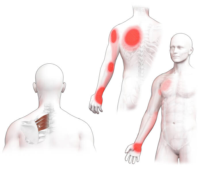serratus posterior superior trigger point​