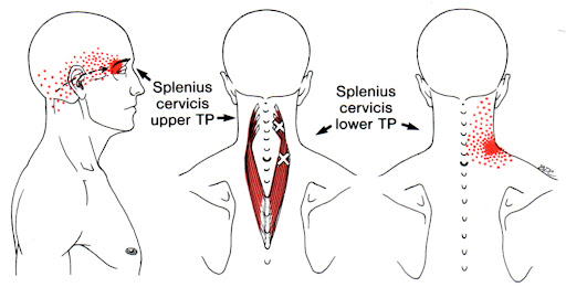 Splenius Cervicis trigger points
