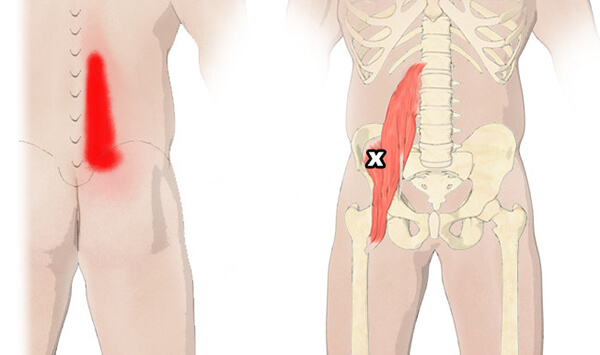 tight iliopsoas for lower back pain