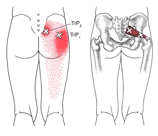 piriformis trigger points