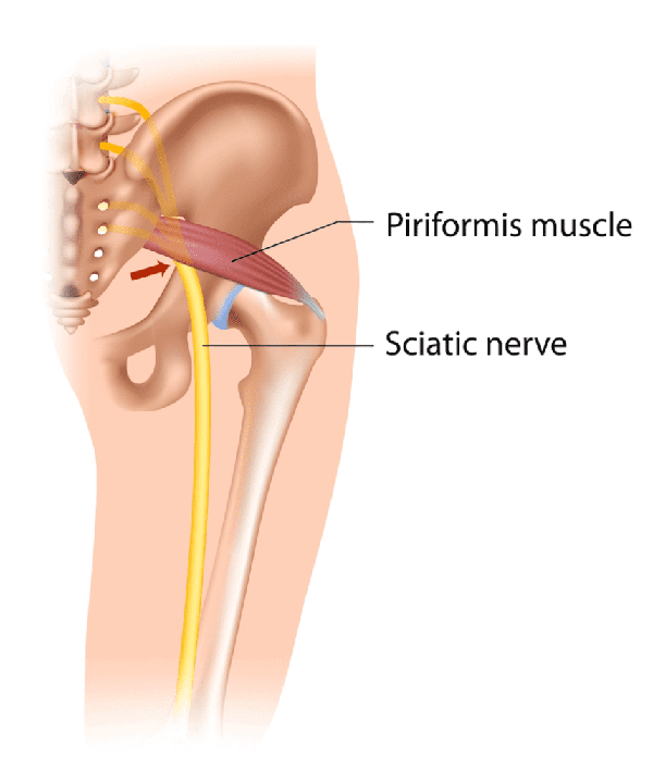piriformis syndrome vs sciatica​