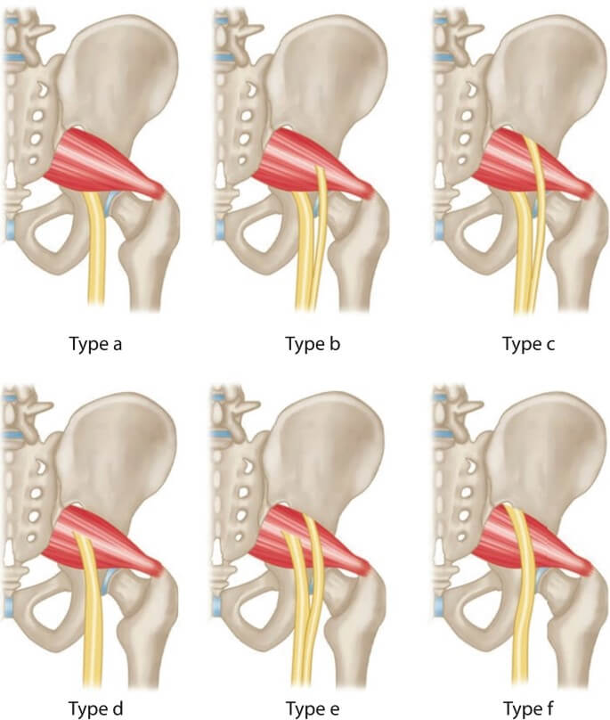 sciatica vs piriformis syndrome