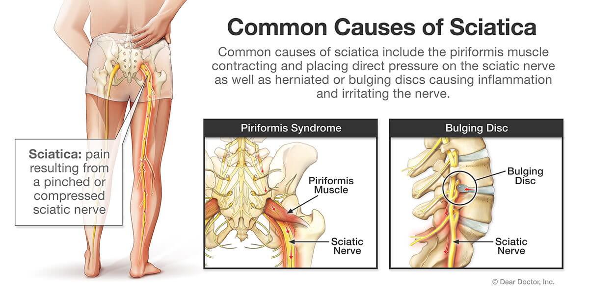 piriformis syndrome vs sciatica