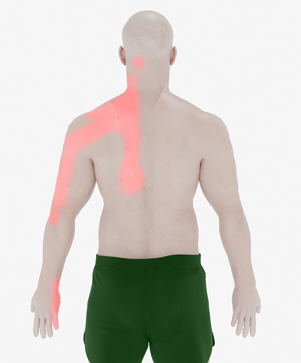 neck and shoulder blade pain radiating down arm