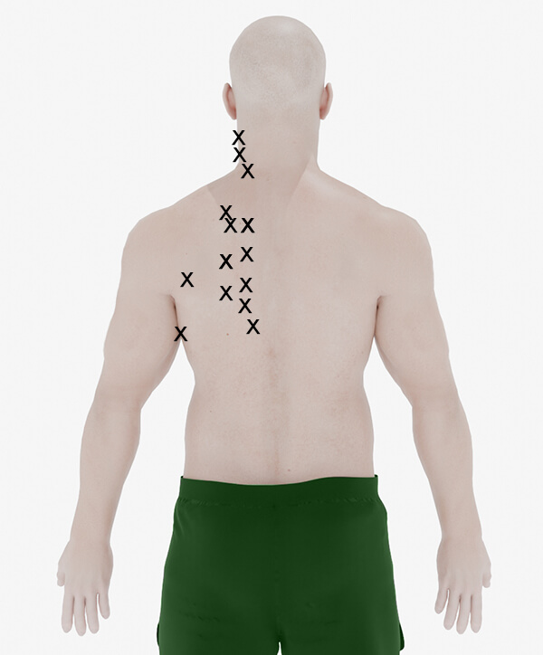 shoulder blade pain trigger points