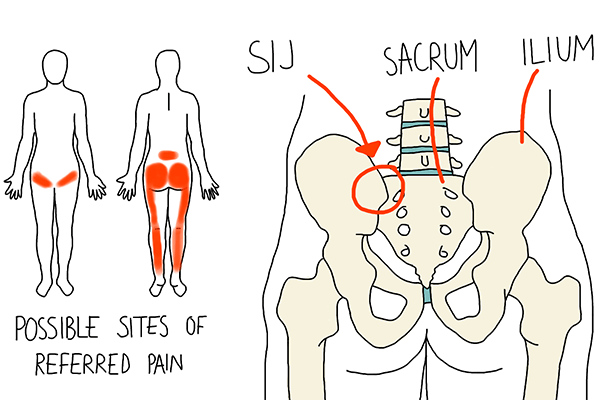 Sacroiliac SI Joint Dysfunction