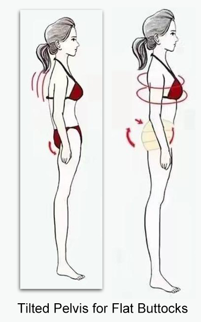 tilted pelvic for flat buttocks syndrome