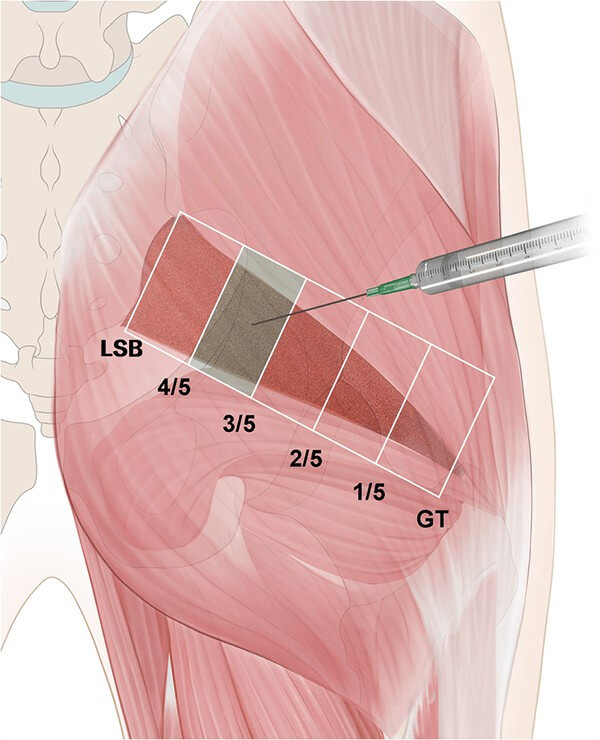 trigger point injection piriformis​