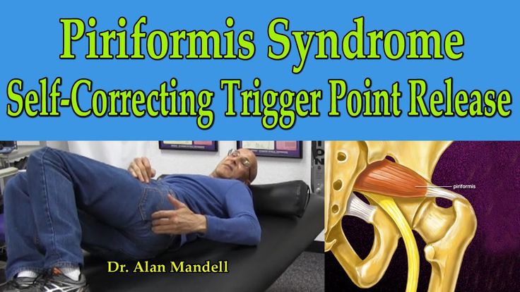 trigger point injection piriformis​