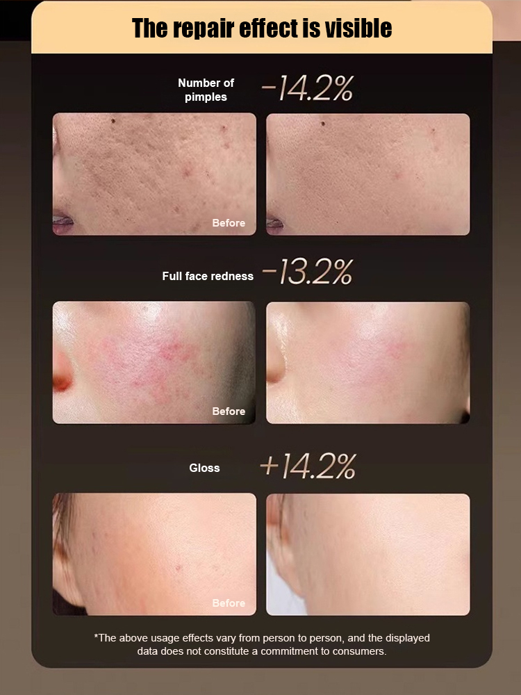 Photorejuvenator red and blue light beauty instrument