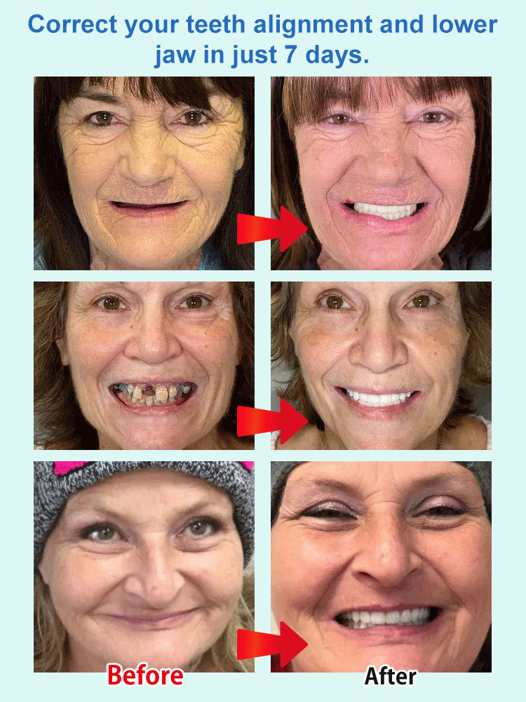 [No Dentist Required] Whitening and Realistic Teeth Whitening Braces