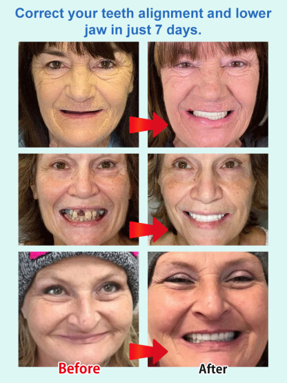 [No Dentist Required] Whitening and Realistic Teeth Whitening Braces