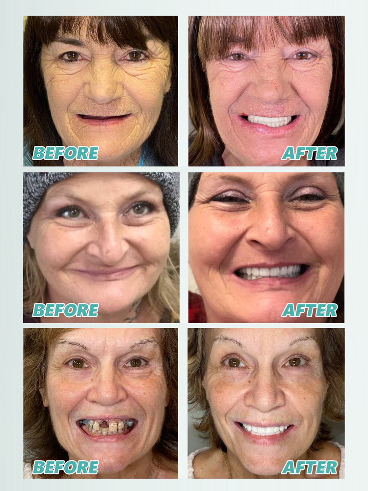 【Best-Selling】Self-Adjusting Fake Denture Set