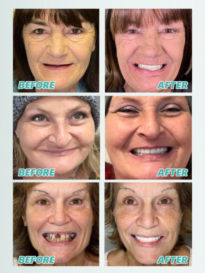 【Best-Selling】Self-Adjusting Fake Denture Set