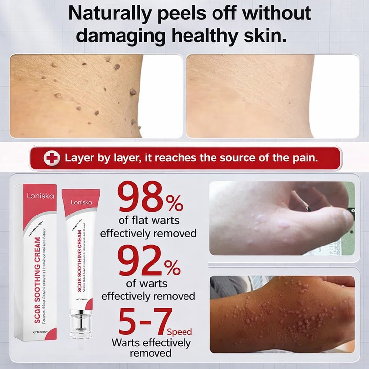 Wart Removal Cream