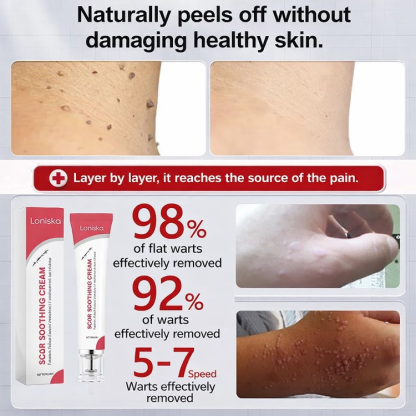 Wart Removal Cream