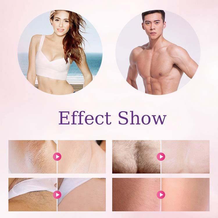 【For Both Men & Women】Smart Painless Hair Removal Device – Achieve Smooth, Radiant Skin in 10 Seconds!