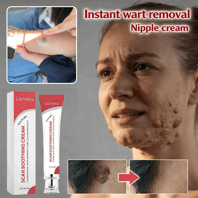 Wart Removal Cream