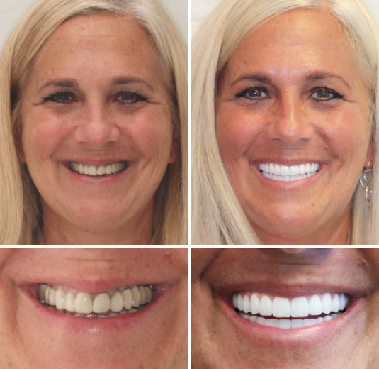 🦷Advanced Customized Full Denture Set🦷 (⏰Limited time discount last 30 minutes⏰)