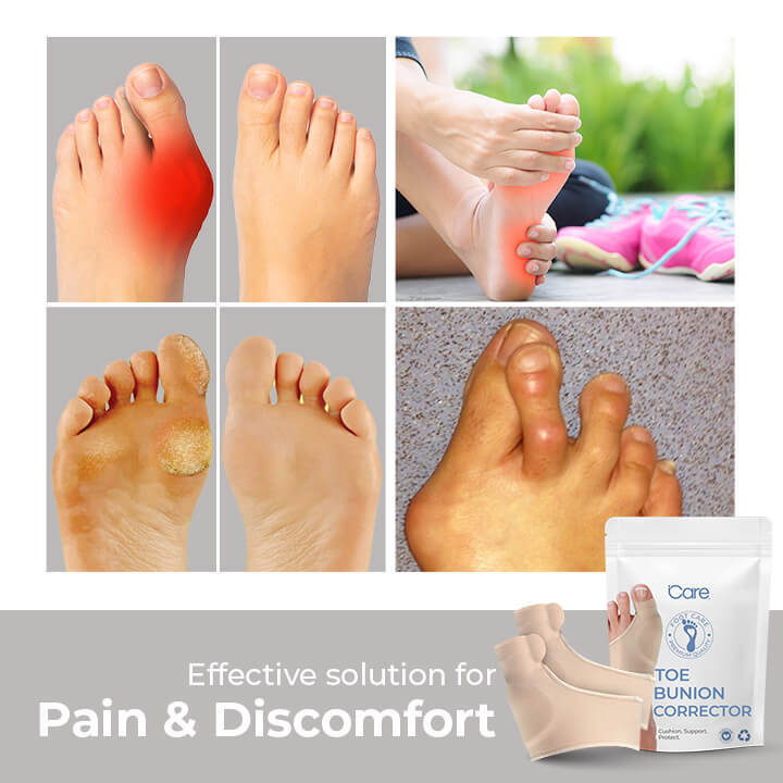 Correct Your Toe Bunion In 7 Day