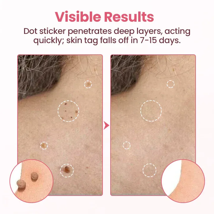 Plasture nedureros Biancat® pentru îndepărtarea negilor micro