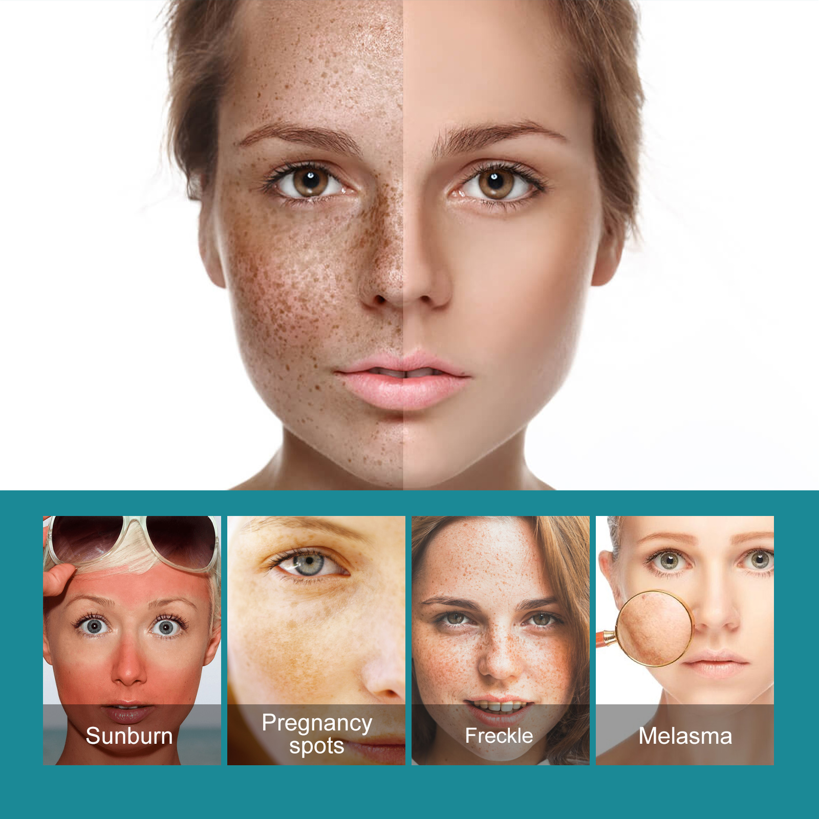 Bleaching freckles cream-CLEJOY