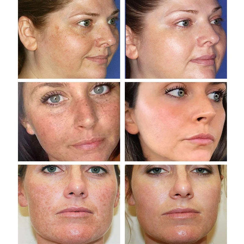 Bleaching freckles cream-CLEJOY
