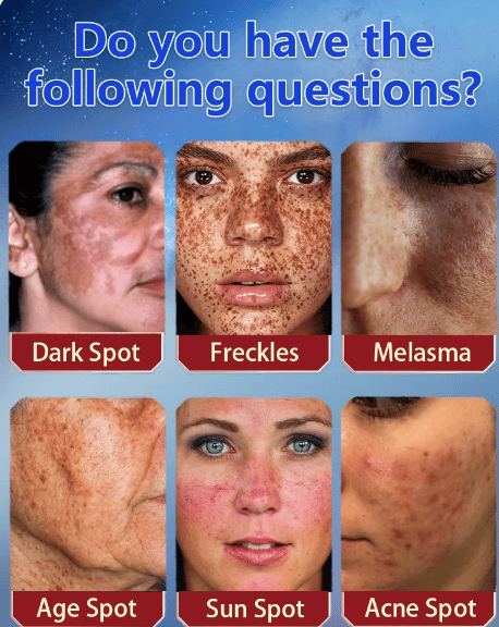 Bleaching freckles cream-CLEJOY