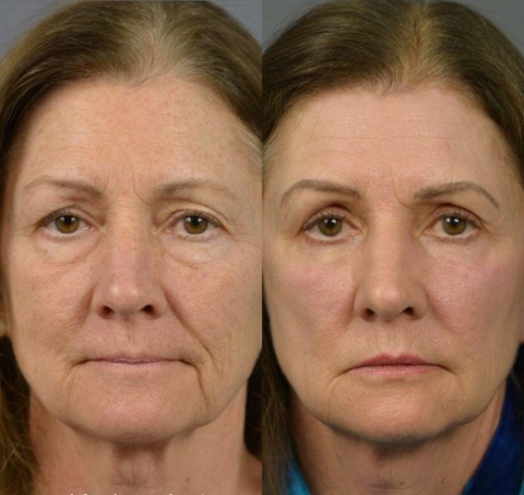 🌸 Instant face Tightener No-Filter Primer