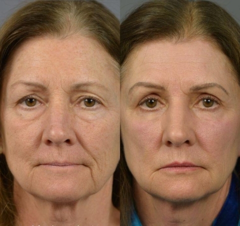 🌸 Instant face Tightener No-Filter Primer