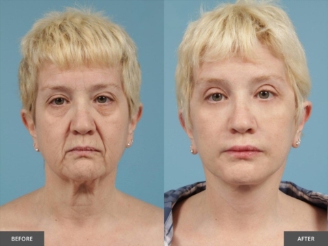 🌸 Instant face Tightener No-Filter Primer
