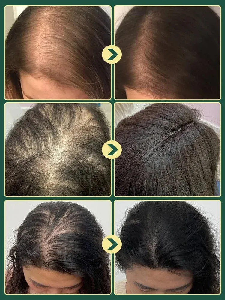 🌿 Rosemary extract + hydrolyzed keratin activate dormant hair follicles, stop hair loss, and promote thicker and longer new hair.
