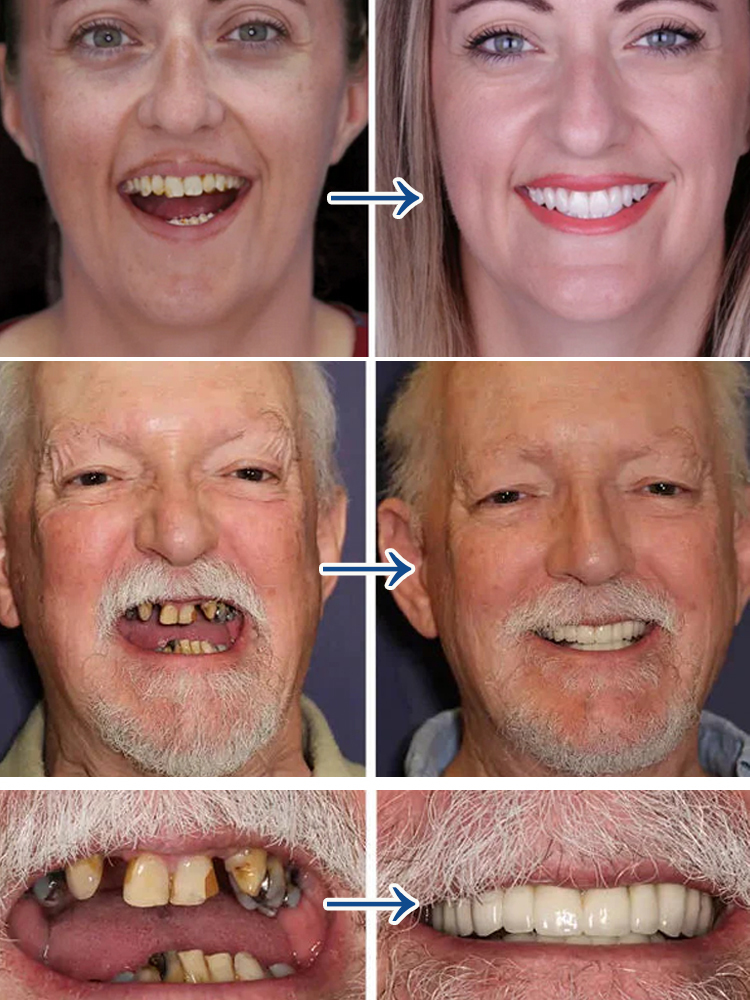 Dentist recommended dentures