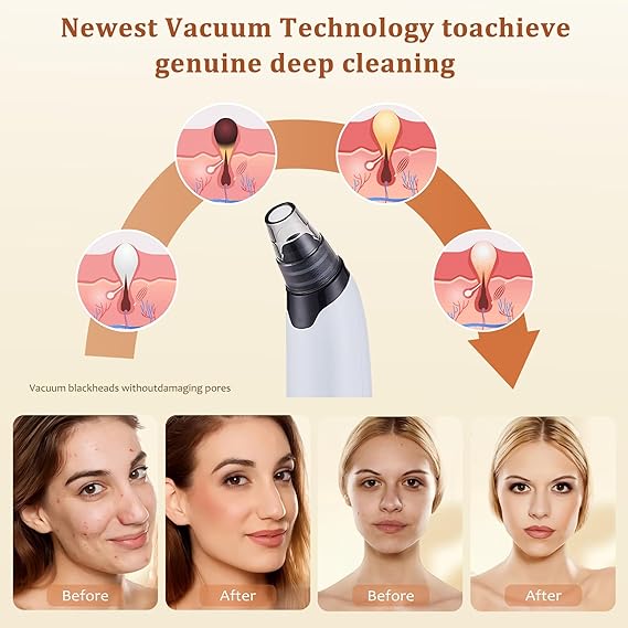 Blackhead Remover Vacuum - Powerful Pore Vacuum for Cleansing, Blackhead Extractor with 3 Adjustable Suction Levels, 4 Blackhead Removal Tools, USB Rechargeable，Suitable for Women and Men