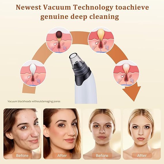 Blackhead Remover Vacuum - Powerful Pore Vacuum for Cleansing, Blackhead Extractor with 3 Adjustable Suction Levels, 4 Blackhead Removal Tools, USB Rechargeable，Suitable for Women and Men