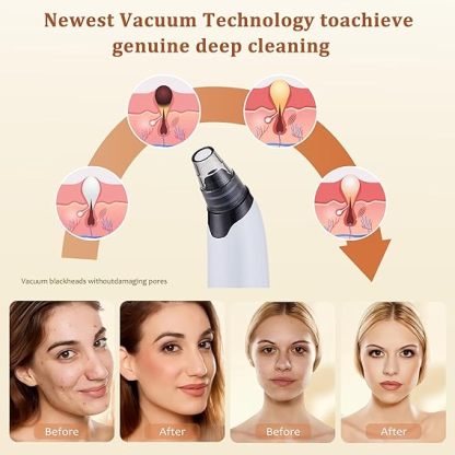 Blackhead Remover Vacuum - Powerful Pore Vacuum for Cleansing, Blackhead Extractor with 3 Adjustable Suction Levels, 4 Blackhead Removal Tools, USB Rechargeable，Suitable for Women and Men