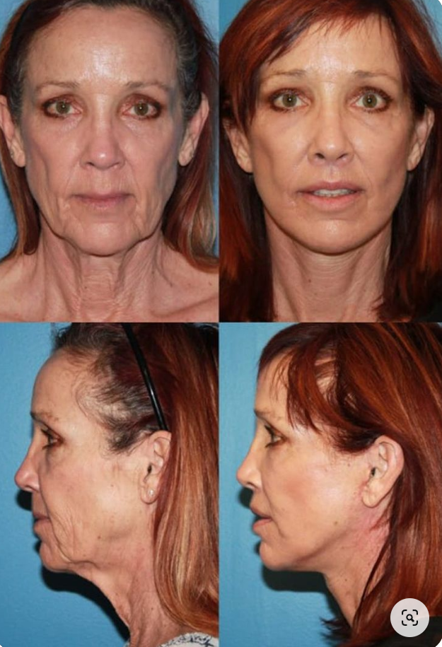 RevitaHepa ™ AHP powerful skin reshape cell drops(🎁Completely eliminate wrinkles and loose skin💯)