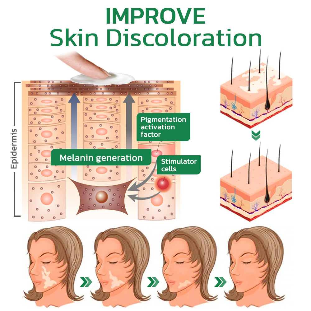 Seurico™ TreatVitiligo Soothing Cream